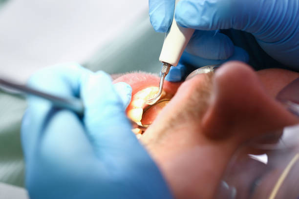 Best Emergency Tooth Extraction in Hartford, MI